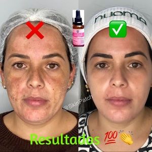 Tonico Despigmentante 🇨🇴 *Eliminador de manchas* Removes dark spots